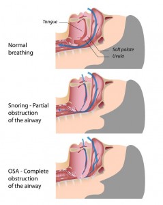 Sleep Apnea Severity Connected to Death Risk