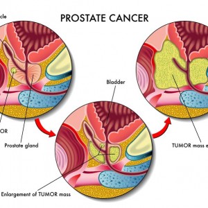 A Good Night’s Sleep May Keep Prostate Cancer Away A Good Night's Sleep For Men May Keep Prostate Cancer Away
