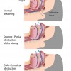 Sleep Apnea Severity Connected to Death Risk